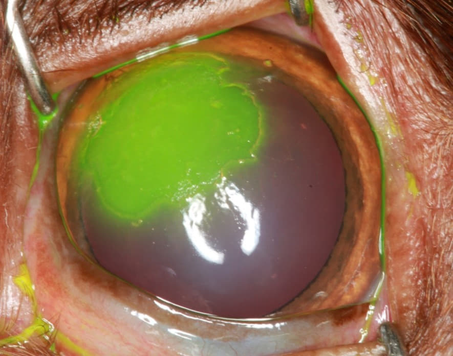 indolent_corneal_ulcer